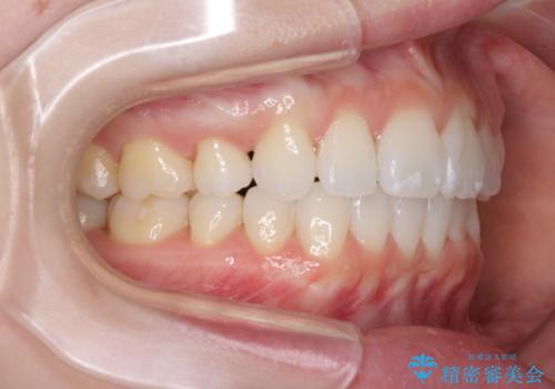 前歯の出っ歯とでこぼこを抜歯矯正で改善　目立たないワイヤー矯正の治療後