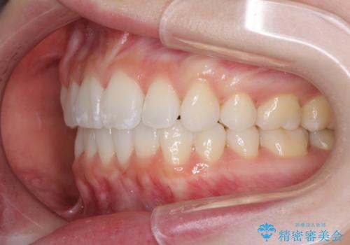 前歯の出っ歯とでこぼこを抜歯矯正で改善　目立たないワイヤー矯正