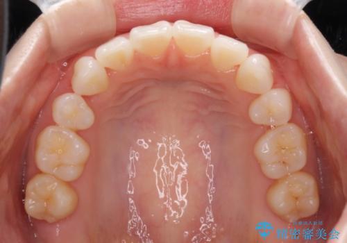 前歯の出っ歯とでこぼこを抜歯矯正で改善　目立たないワイヤー矯正の治療後