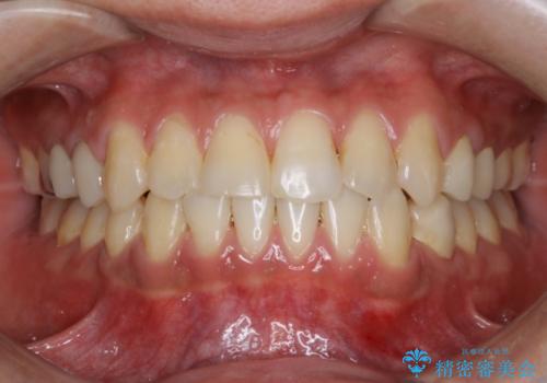 前歯の反対咬合　インビザラインできれいに修正の治療後