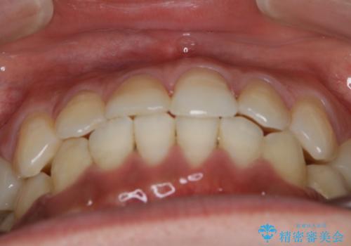 前歯の反対咬合　インビザラインできれいに修正の治療後