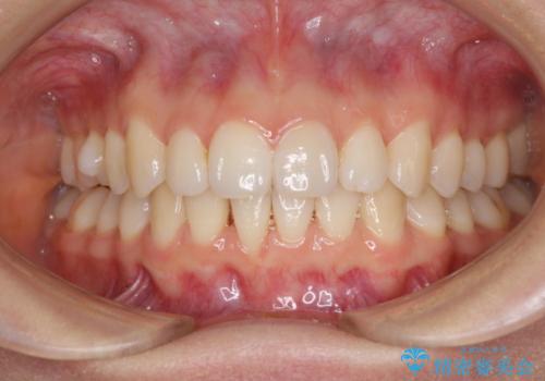 上の出っ歯を治したい　インビザラインによる非抜歯矯正治療