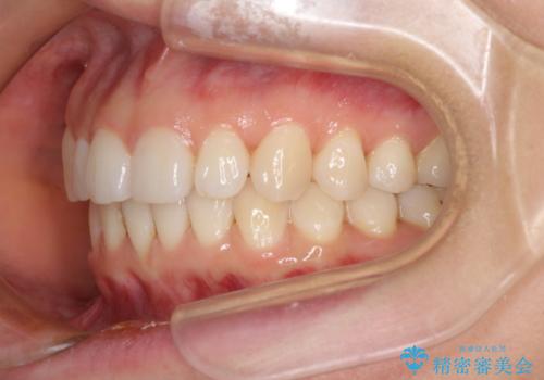 上の出っ歯を治したい　インビザラインによる非抜歯矯正治療の治療後