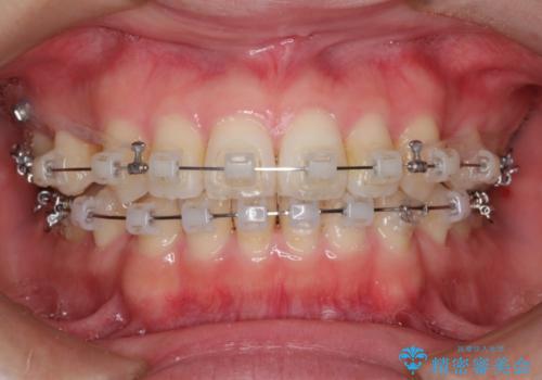 表側のワイヤー矯正　口元の改善をはかる抜歯矯正の治療中