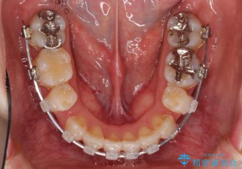 表側のワイヤー矯正　口元の改善をはかる抜歯矯正の治療中