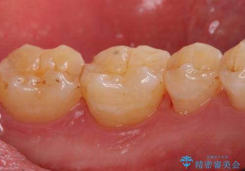 歯の周り、歯肉の中に付着していた歯石を超音波にて除去の治療後