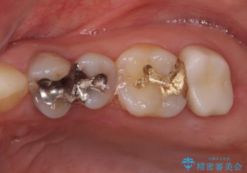 奥歯が痛い　歯の欠損と虫歯による奥歯の痛みを改善