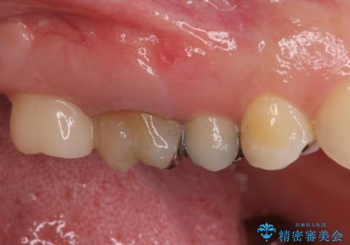奥歯が痛い　歯の欠損と虫歯による奥歯の痛みを改善の治療後