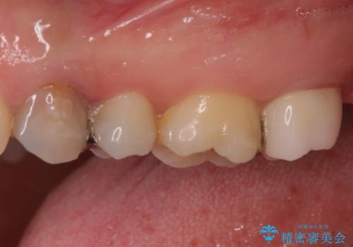 奥歯が痛い　歯の欠損と虫歯による奥歯の痛みを改善の治療後