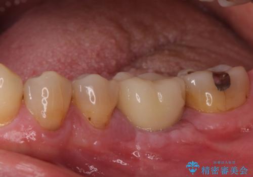 奥歯の割れてしまった歯　ストローマンインプラントによる咬合回復の治療後