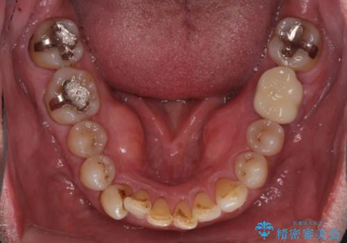 奥歯の割れてしまった歯　ストローマンインプラントによる咬合回復の治療後