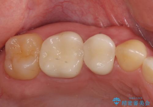 奥の銀歯を白くしたい　オールセラミッククラウンによる補綴治療の治療後