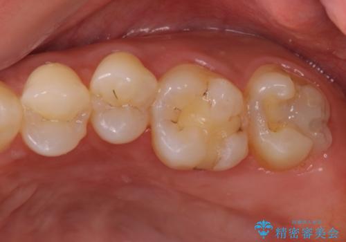 奥歯の虫歯をゴールドインレーで修復治療の治療中