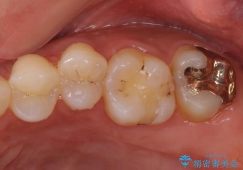 奥歯の虫歯をゴールドインレーで修復治療の治療後