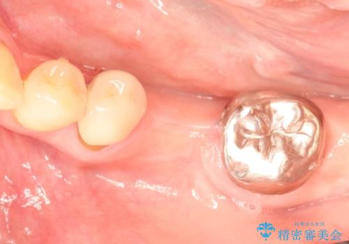 ショートインプラントによる奥歯の咬み合わせの回復治療の治療中