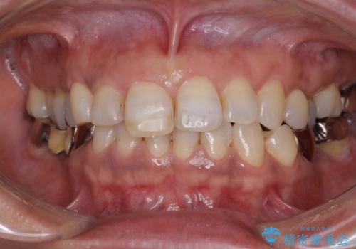 奥歯が抜けそう　部分矯正による咬み合わせの改善とインプラントによる補綴治療の治療前