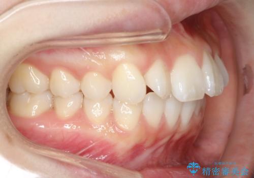前歯の出っ歯とでこぼこを抜歯矯正で改善　目立たないワイヤー矯正の治療前