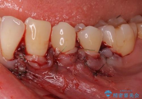 歯根の露出を隠したい　歯肉移植による根面被覆の治療中