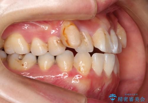 ハーフリンガルによる八重歯の治療　3incisor(3本前歯)症例の治療前