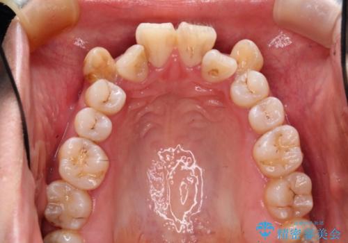 ハーフリンガルによる八重歯の治療　3incisor(3本前歯)症例の治療前