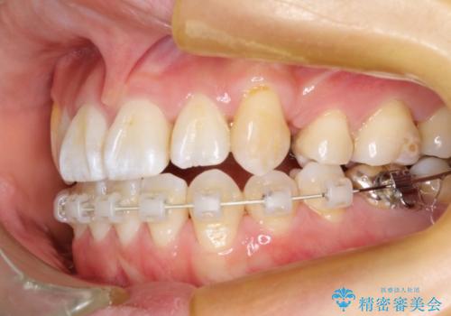 ハーフリンガルによる八重歯の治療　3incisor(3本前歯)症例の治療中