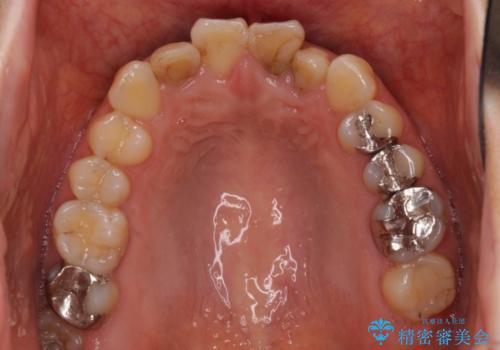 前歯の歯並びと変色を改善　インビザラインとオールセラミックの治療前