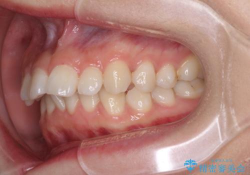 上の出っ歯を治したい　インビザラインによる非抜歯矯正治療の治療前