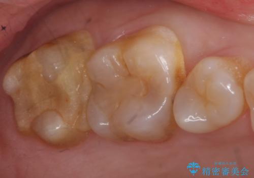 PGA(ゴールド)クラウン・セラミックインレー　治療途中で放置してしまった歯の治療の治療前