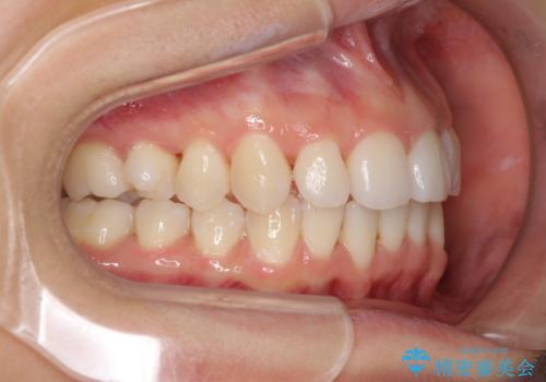 上の出っ歯を治したい　インビザラインによる非抜歯矯正治療の治療中