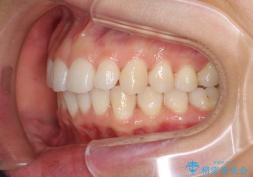上の出っ歯を治したい　インビザラインによる非抜歯矯正治療の治療中
