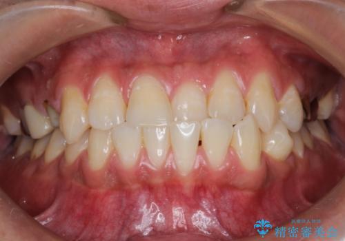 前歯の反対咬合　インビザラインできれいに修正の治療前