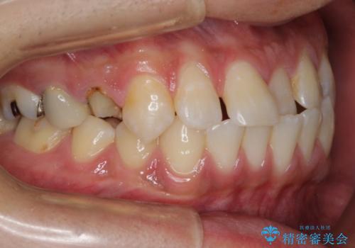 前歯の反対咬合　インビザラインできれいに修正の治療前
