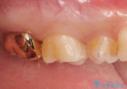 PGA(ゴールド)クラウン・セラミックインレー　治療途中で放置してしまった歯の治療の治療後