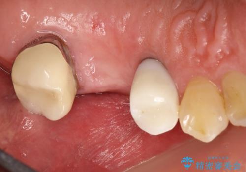 歯根破折により抜歯となってしまった奥歯のインプラントによる咬み合わせ回復の治療前