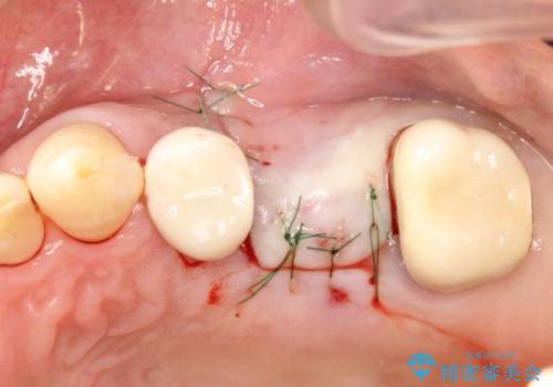 歯根破折により抜歯となってしまった奥歯のインプラントによる咬み合わせ回復の治療中