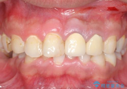 オールセラミッククラウン　前歯の審美治療の治療前