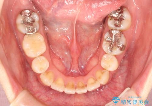 表側のワイヤー矯正　口元の改善をはかる抜歯矯正の治療後
