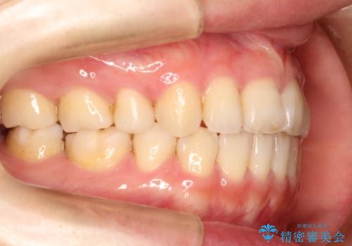 表側のワイヤー矯正　口元の改善をはかる抜歯矯正の治療後