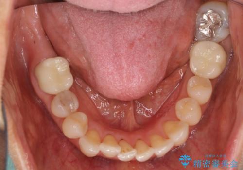 目立つ銀歯を白くしたい　銀歯からセラミックへの再補綴の治療後
