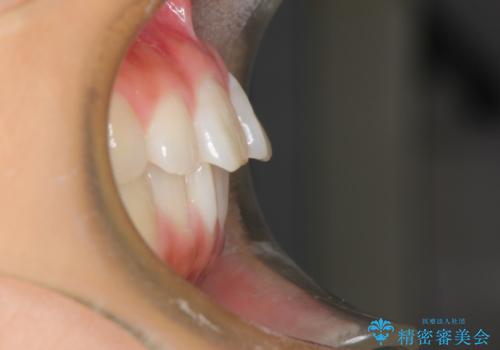 インビザラインで前歯のデコボコを目立たず矯正の治療前