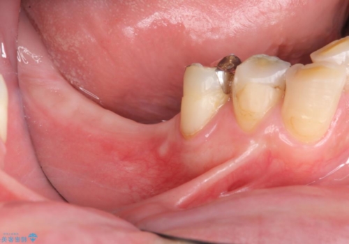 奥歯の欠損　インプラントによる機能回復の治療前