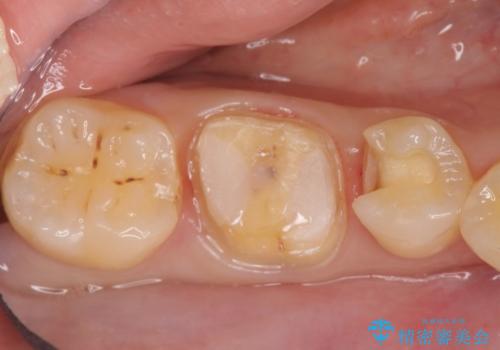 メタルボンドクラウン　PGA(ゴールド)インレー　虫歯治療の治療中