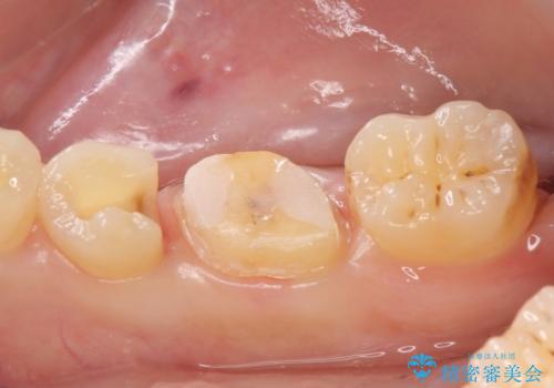 メタルボンドクラウン　PGA(ゴールド)インレー　虫歯治療の治療中