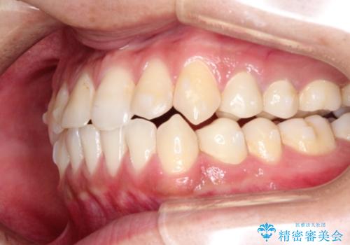 前歯の反対咬合　インビザラインできれいに修正の治療中