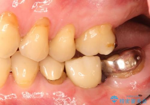 ショートインプラントによる奥歯の咬み合わせの回復治療の治療後