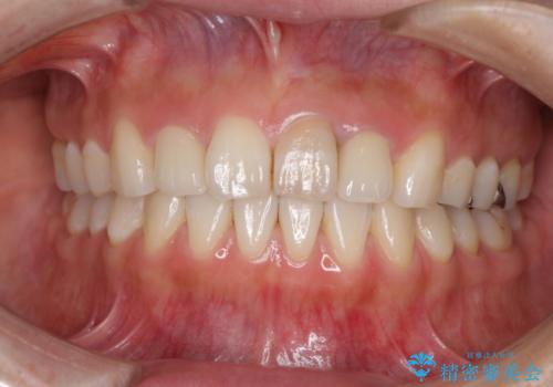 前歯の歯並びと変色を改善　インビザラインとオールセラミックの治療後