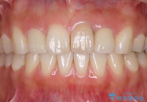 前歯の歯並びと変色を改善　インビザラインとオールセラミック