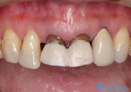 前歯の被せものの治療前