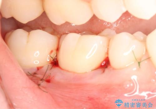 侵襲性歯周炎によるシビアな骨欠損　再生治療で回復の治療中