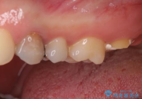 奥歯が痛い　歯の欠損と虫歯による奥歯の痛みを改善の治療前